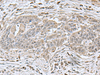 Immunohistochemistry of paraffin-embedded Human esophagus cancer tissue  using NEUROG3 Polyclonal Antibody at dilution of 1:70(×200)