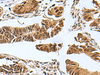 Immunohistochemistry of paraffin-embedded Human colorectal cancer tissue  using PDCD5 Polyclonal Antibody at dilution of 1:55(×200)
