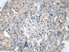 Immunohistochemistry of paraffin-embedded Human liver cancer tissue  using TGM3 Polyclonal Antibody at dilution of 1:55(×200)