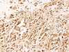 Immunohistochemistry of paraffin-embedded Human prost ate cancer tissue  using TERF1 Polyclonal Antibody at dilution of 1:30(×200)