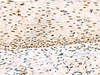 Immunohistochemistry of paraffin-embedded Human cervical cancer tissue  using ABI2 Polyclonal Antibody at dilution of 1:45(×200)