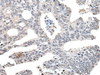 Immunohistochemistry of paraffin-embedded Human colorectal cancer tissue  using TCEB2 Polyclonal Antibody at dilution of 1:40(×200)
