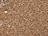 Immunohistochemistry of paraffin-embedded Human lung cancer tissue  using LAMTOR5 Polyclonal Antibody at dilution of 1:35(×200)