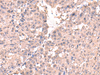 Immunohistochemistry of paraffin-embedded Human liver cancer tissue  using HPN Polyclonal Antibody at dilution of 1:50(×200)