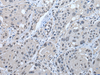 Immunohistochemistry of paraffin-embedded Human esophagus cancer tissue  using STRADA Polyclonal Antibody at dilution of 1:45(×200)