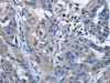 Immunohistochemistry of paraffin-embedded Human breast cancer tissue  using PLK4 Polyclonal Antibody at dilution of 1:50(×200)