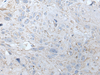 Immunohistochemistry of paraffin-embedded Human esophagus cancer tissue  using RASA1 Polyclonal Antibody at dilution of 1:40(×200)