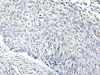 Immunohistochemistry of paraffin-embedded Human lung cancer tissue  using RERG Polyclonal Antibody at dilution of 1:65(×200)