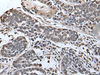 Immunohistochemistry of paraffin-embedded Human esophagus cancer tissue  using SLITRK5 Polyclonal Antibody at dilution of 1:45(×200)