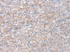 Immunohistochemistry of paraffin-embedded Human prost ate cancer tissue  using STK16 Polyclonal Antibody at dilution of 1:30(×200)