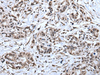 Immunohistochemistry of paraffin-embedded Human gastric cancer tissue  using TIA1 Polyclonal Antibody at dilution of 1:30(×200)