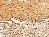 Immunohistochemistry of paraffin-embedded Human cervical cancer tissue  using UBLCP1 Polyclonal Antibody at dilution of 1:80(×200)