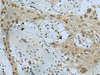Immunohistochemistry of paraffin-embedded Human esophagus cancer tissue  using WDR4 Polyclonal Antibody at dilution of 1:40(×200)
