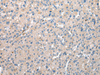 Immunohistochemistry of paraffin-embedded Human liver cancer tissue  using DCAF7 Polyclonal Antibody at dilution of 1:30(×200)