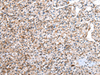 Immunohistochemistry of paraffin-embedded Human prost ate cancer tissue  using DCAF7 Polyclonal Antibody at dilution of 1:30(×200)