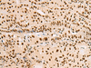 Immunohistochemistry of paraffin-embedded Human thyroid cancer tissue  using XRCC4 Polyclonal Antibody at dilution of 1:60(×200)