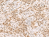 Immunohistochemistry of paraffin-embedded Human ovarian cancer tissue  using XRCC4 Polyclonal Antibody at dilution of 1:60(×200)