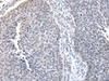 Immunohistochemistry of paraffin-embedded Human lung cancer tissue  using ZNF23 Polyclonal Antibody at dilution of 1:50(×200)