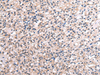 Immunohistochemistry of paraffin-embedded Human liver cancer tissue  using RNF115 Polyclonal Antibody at dilution of 1:45(×200)