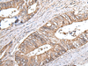 Immunohistochemistry of paraffin-embedded Human colorectal cancer tissue  using ZNHIT1 Polyclonal Antibody at dilution of 1:40(×200)