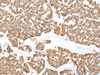 Immunohistochemistry of paraffin-embedded Human esophagus cancer tissue  using NDUFB3 Polyclonal Antibody at dilution of 1:25(×200)