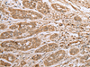 Immunohistochemistry of paraffin-embedded Human esophagus cancer tissue  using ATXN7L3 Polyclonal Antibody at dilution of 1:40(×200)
