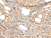 Immunohistochemistry of paraffin-embedded Human thyroid cancer tissue  using ATXN7L3 Polyclonal Antibody at dilution of 1:40(×200)