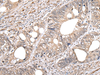 Immunohistochemistry of paraffin-embedded Human colorectal cancer tissue  using GCNT2 Polyclonal Antibody at dilution of 1:60(×200)