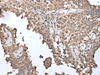 Immunohistochemistry of paraffin-embedded Human ovarian cancer tissue  using METAP1D Polyclonal Antibody at dilution of 1:40(×200)