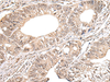 Immunohistochemistry of paraffin-embedded Human colorectal cancer tissue  using METAP1D Polyclonal Antibody at dilution of 1:40(×200)