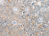 Immunohistochemistry of paraffin-embedded Human prost at e cancer tissue  using COMMD6 Polyclonal Antibody at dilution of 1:45(×200)