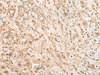 Immunohistochemistry of paraffin-embedded Human liver cancer tissue  using NUDT12 Polyclonal Antibody at dilution of 1:25(×200)
