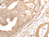 Immunohistochemistry of paraffin-embedded Human gastric cancer tissue  using GRAP Polyclonal Antibody at dilution of 1:40(×200)