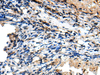 Immunohistochemistry of paraffin-embedded Human lung cancer tissue  using CSRP3 Polyclonal Antibody at dilution of 1:40(×200)