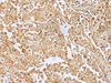 Immunohistochemistry of paraffin-embedded Human colorectal cancer tissue  using RILPL2 Polyclonal Antibody at dilution of 1:30(×200)