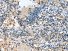 Immunohistochemistry of paraffin-embedded Human lung cancer tissue  using MOB4 Polyclonal Antibody at dilution of 1:25(×200)