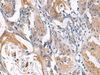 Immunohistochemistry of paraffin-embedded Human esophagus cancer tissue  using LYPLA1 Polyclonal Antibody at dilution of 1:45(×200)