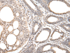 Immunohistochemistry of paraffin-embedded Human gastric cancer tissue  using ZNF281 Polyclonal Antibody at dilution of 1:30(×200)