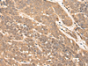 Immunohistochemistry of paraffin-embedded Human thyroid cancer tissue  using ZPR1 Polyclonal Antibody at dilution of 1:40(×200)