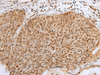 Immunohistochemistry of paraffin-embedded Human cervical cancer tissue  using ZNF354A Polyclonal Antibody at dilution of 1:40(×200)