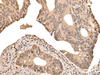 Immunohistochemistry of paraffin-embedded Human colorectal cancer tissue  using ZSCAN12 Polyclonal Antibody at dilution of 1:50(×200)