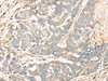 Immunohistochemistry of paraffin-embedded Human thyroid cancer tissue  using CD55 Polyclonal Antibody at dilution of 1:35(×200)