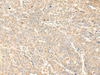Immunohistochemistry of paraffin-embedded Human liver cancer tissue  using WDFY4 Polyclonal Antibody at dilution of 1:50(×200)