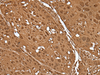 Immunohistochemistry of paraffin-embedded Human esophagus cancer tissue  using VCP Polyclonal Antibody at dilution of 1:30(×200)