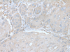 Immunohistochemistry of paraffin-embedded Human esophagus cancer tissue  using USO1 Polyclonal Antibody at dilution of 1:30(×200)