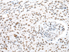 Immunohistochemistry of paraffin-embedded Human lung cancer tissue  using SNRPA Polyclonal Antibody at dilution of 1:30(×200)