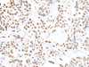Immunohistochemistry of paraffin-embedded Human prost ate cancer tissue  using SNRPA Polyclonal Antibody at dilution of 1:30(×200)
