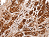 Immunohistochemistry of paraffin-embedded Human breast cancer tissue  using UBE2V1 Polyclonal Antibody at dilution of 1:30(×200)