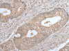 Immunohistochemistry of paraffin-embedded Human colorectal cancer tissue  using UQCRQ Polyclonal Antibody at dilution of 1:45(×200)