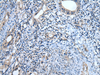 Immunohistochemistry of paraffin-embedded Human cervical cancer tissue  using USP32 Polyclonal Antibody at dilution of 1:75(×200)